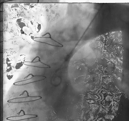 冠脉造影技术成熟不,跟我学技术分析从入门到精通