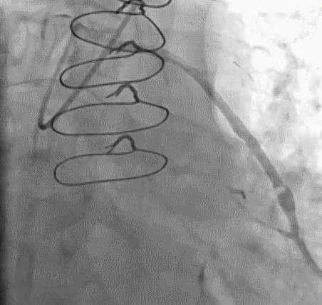 冠脉造影技术成熟不,跟我学技术分析从入门到精通