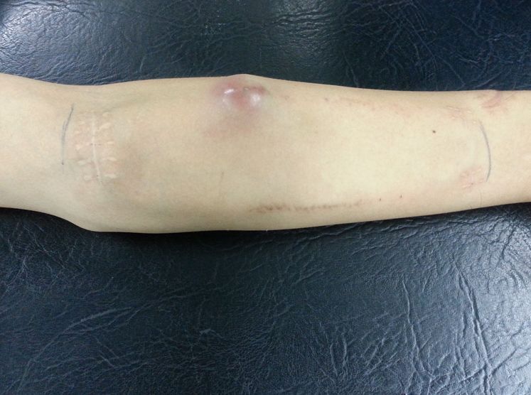 血透动静脉内瘘手术三种术式图解,血透室动静脉内瘘穿刺及护理