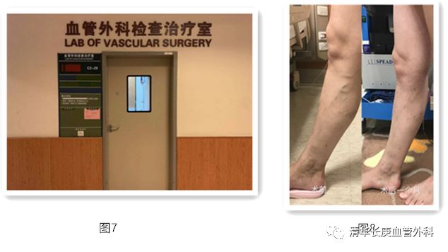 胃底静脉曲张,睾丸静脉曲张