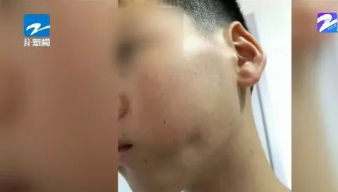 拔智齿导致面部凹陷,在医院拔智齿引发脸肿