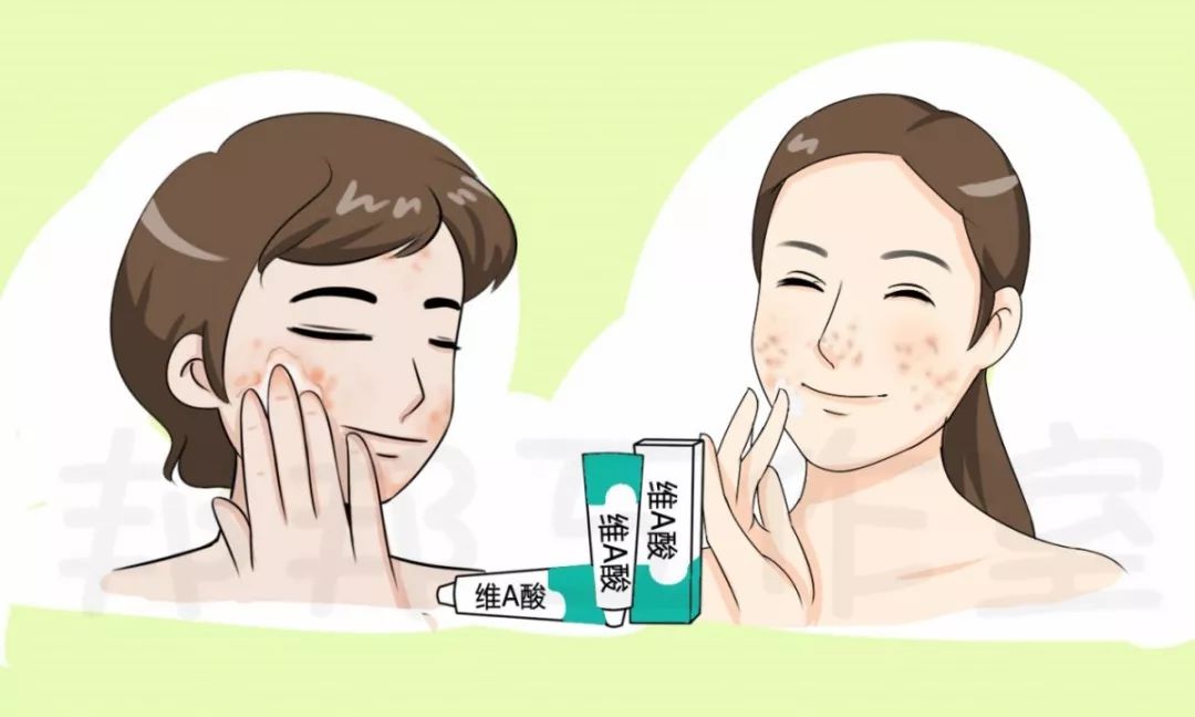 治疗痘痘的维a酸乳膏你用对了吗,治痘痘维a酸最多用多久