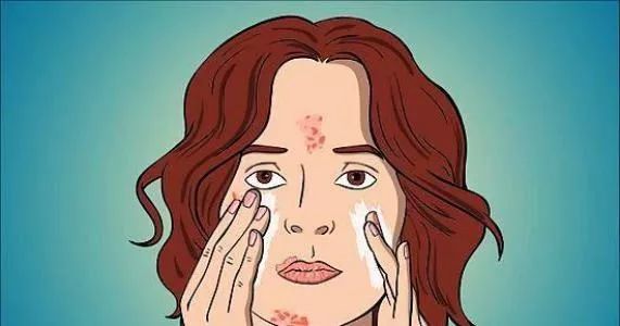 治疗痘痘的维a酸乳膏你用对了吗,治痘痘维a酸最多用多久