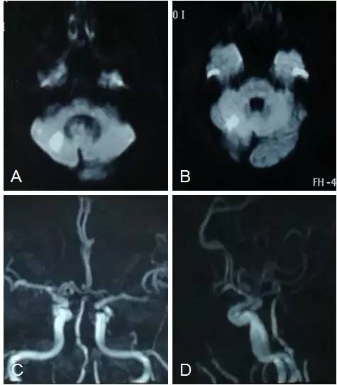 天坛周记·第147期｜右椎动脉V3-4段闭塞血管内介入治疗开通失败1例
