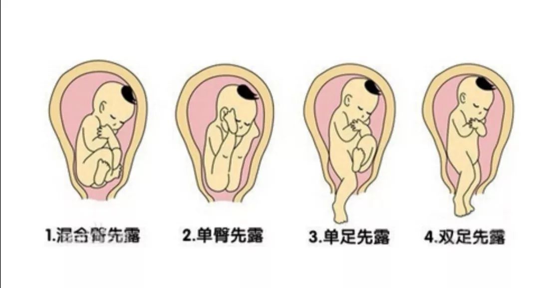 胎儿臀位分娩过程,臀位阴道分娩何时堵臀