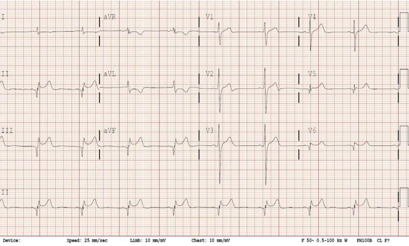 异常q波心电图怎么看图解,异常q波心脏彩超有什么表现