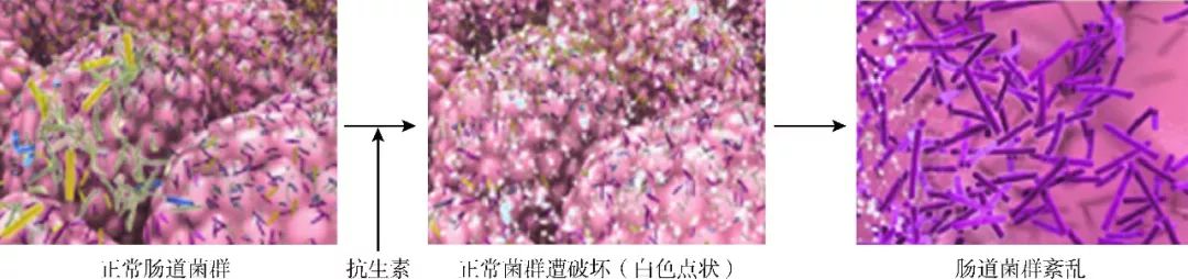 抗生素相关性腹泻,肠道菌群失调和肠炎的区别