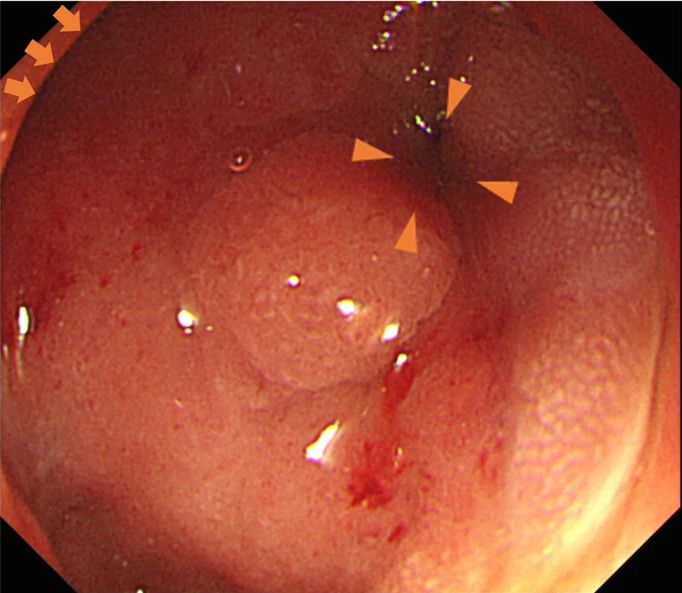 十二指肠腺癌2.5厘米几期,十二指肠癌罕见