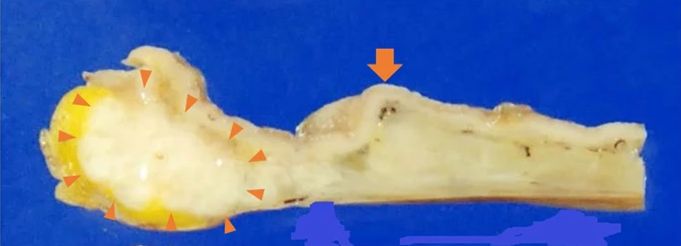 十二指肠腺癌2.5厘米几期,十二指肠癌罕见