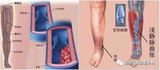 世界血栓日警惕房颤导致中风,世界血栓日的新闻报道