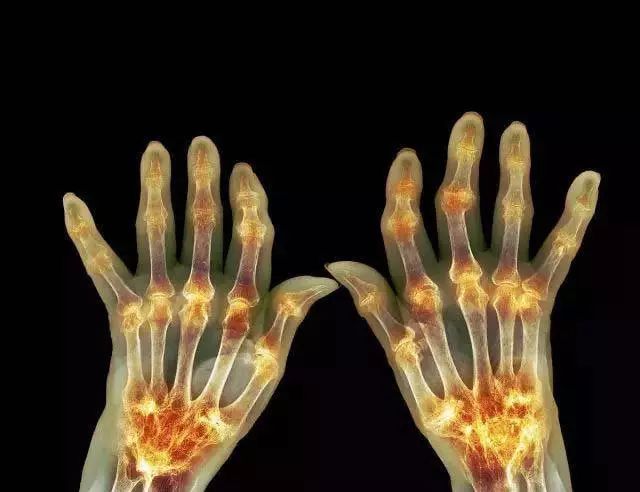 健康中国治疗类风湿性关节炎案例,风湿疾病的现状