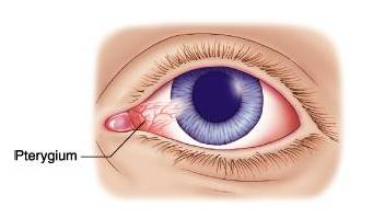 西海岸眼科专家,青岛西海岸中心医院眼科病例
