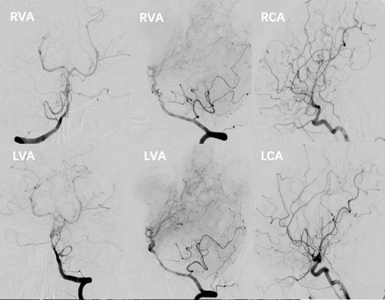 穆如清风·第13期｜Tubridge治疗基底动脉巨大夹层动脉瘤