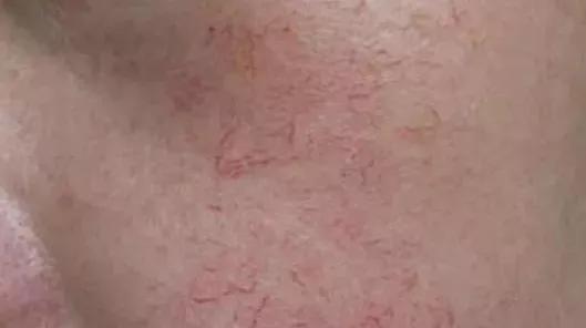 脸部去红血丝的有效方法,去红血丝的有效方法