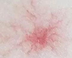 脸部去红血丝的有效方法,去红血丝的有效方法