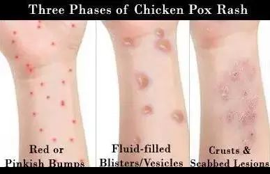 深圳打水痘疫苗免费吗,水痘疫苗哪些城市是免费的