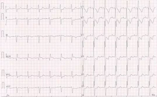 专栏丨贾卫滨：心电图“掉头”现象的鉴别诊断与发生机制（3）