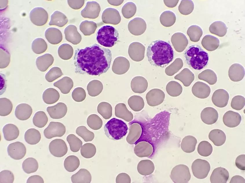 套细胞淋巴瘤胸腔侵润病例分享