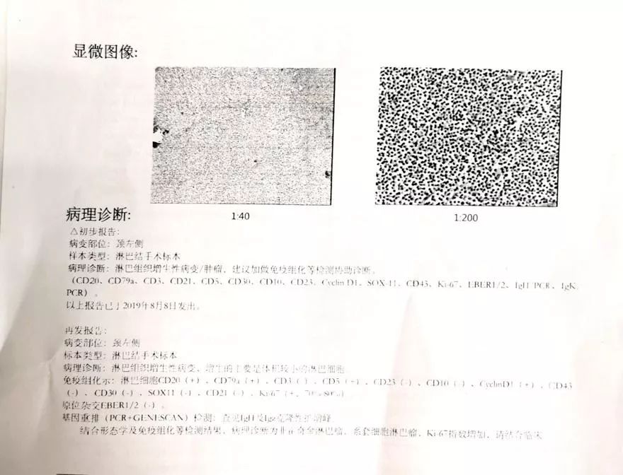 套细胞淋巴瘤胸腔侵润病例分享