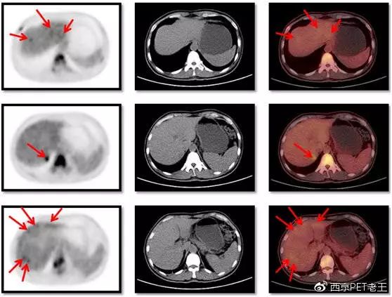 吸烟30年肺部ct图片,抽烟十年20年30年肺部的真实影像