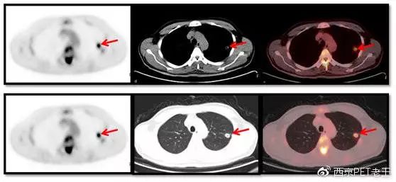 吸烟30年肺部ct图片,抽烟十年20年30年肺部的真实影像