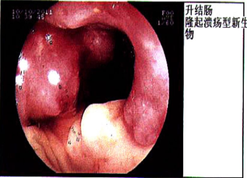 升结肠癌肝转移，如何实现治愈“神话”？|病例分享