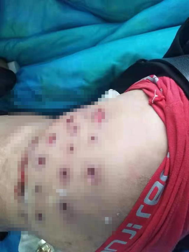 针灸造成感染算医疗事故吗,小诊所针灸出现医疗事故怎么处理