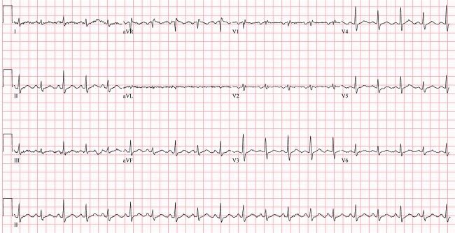 致命胸痛的10个常见部位,致命性胸痛的常见病因有哪些