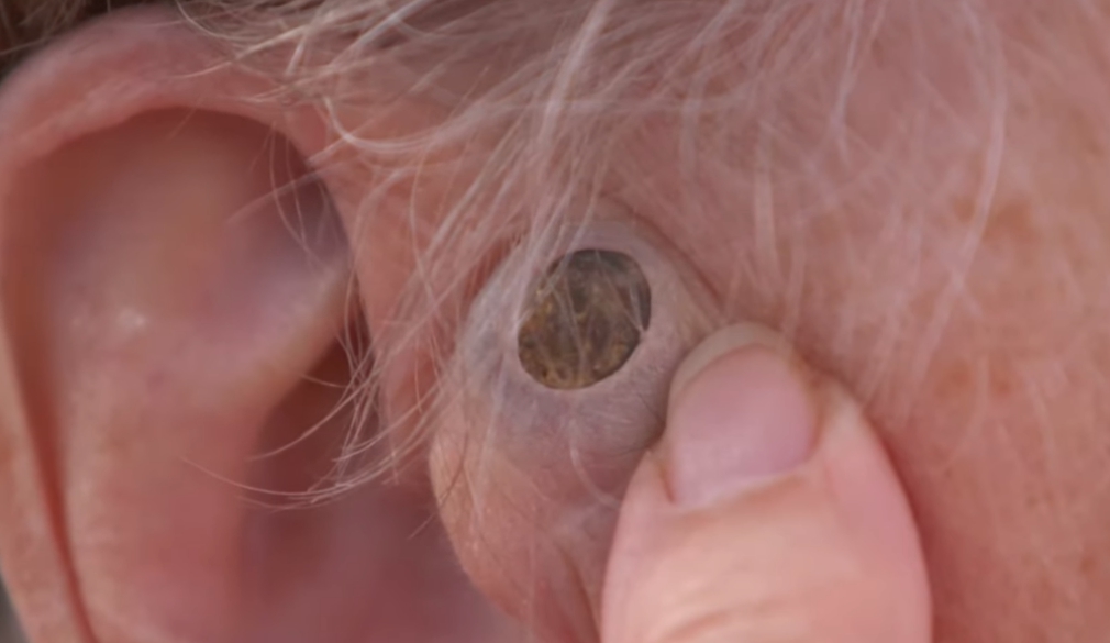 嬷耳边长55年老黑头医吓：是独角兽的毛