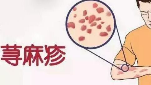 身上同时患了多种皮肤病什么原因,一到冬天全身痒怎么治