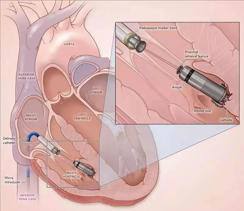 华西医院无导线心脏起搏器多少钱,人工心脏植入四川首例