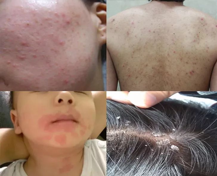 法国Lérane草本净螨贴，萃取天然植物，除螨更安心