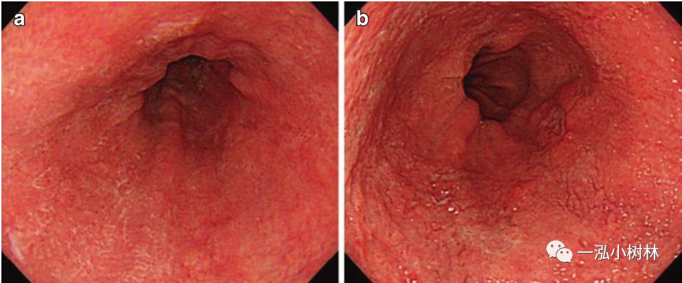 消化道早期癌内镜诊断技巧图谱,早期消化道肿瘤内镜下黏膜剥离术