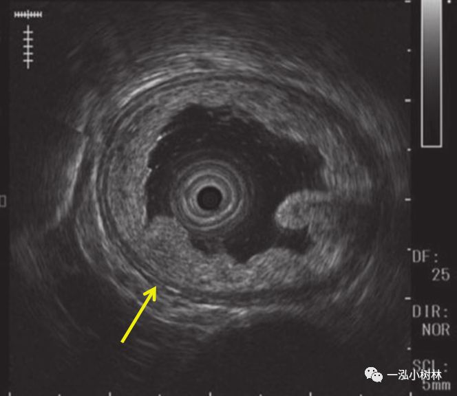 消化道早期癌内镜诊断技巧图谱,早期消化道肿瘤内镜下黏膜剥离术