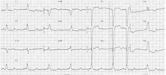 完全性房室传导阻滞病程进展,ii度i型房室传导阻滞治疗
