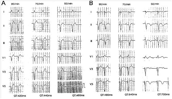 完全性房室传导阻滞病程进展,ii度i型房室传导阻滞治疗