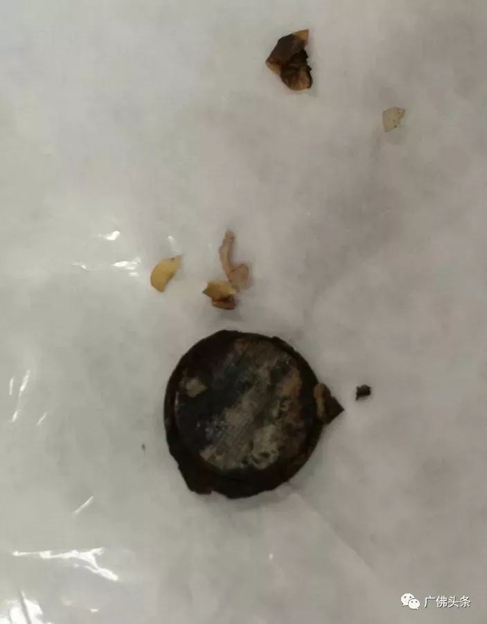 小儿食管化学性烧伤怎么办,孩子食道灼伤怎么办