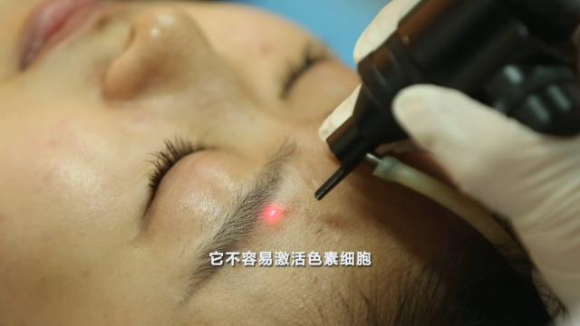 激光去除红褐斑,激光祛褐青斑会反弹吗