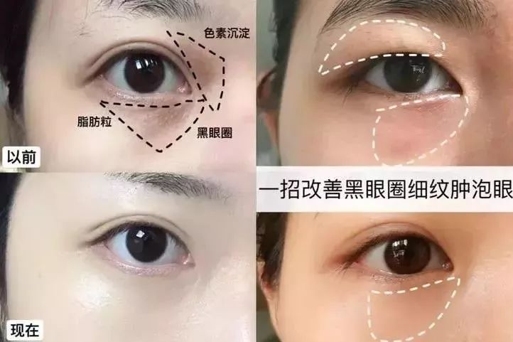 马应龙水晶眼膜视频,马应龙八宝多肽眼膜