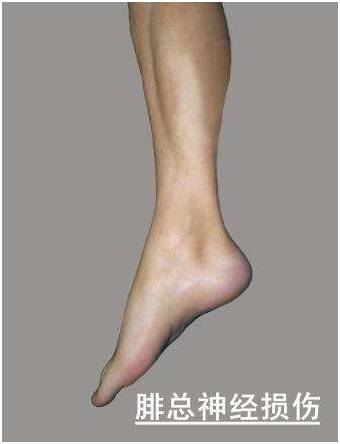 腓总神经损伤康复动作,腓神经损伤康复视频