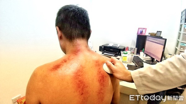 中医刮痧学关注事项,中医基础知识自学入门刮痧