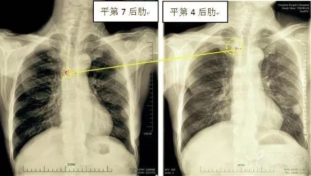 picc置管期间的主要并发症有,picc置管最常见的并发症