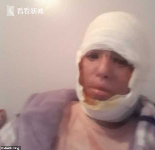 女子熟睡中惨遭毒手,熟睡烧伤女孩后续