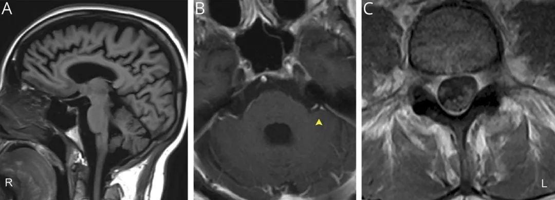 这个慢性进行性疾病患者，为何出现急性、亚急性症状？丨临床推理