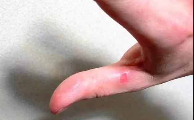 穿着衣服被开水烫伤急救,开水烫伤的急救措施