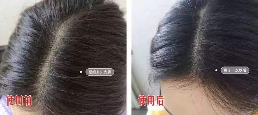 头上的螨虫用什么方法消除,头上又油又痒