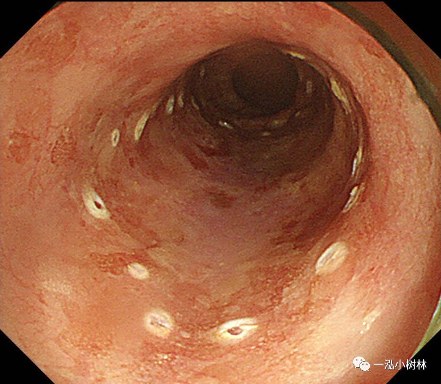 食管癌早期内镜esd治疗能活多久,食管癌内镜esd手术后几天出院