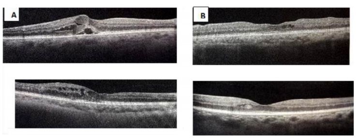 治疗糖尿病眼病吃什么药,高压氧对糖尿病有好处吗
