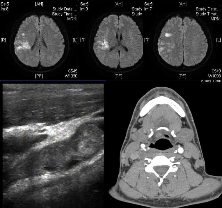 颈内动脉血栓和闭塞,颈内动脉漂浮血栓