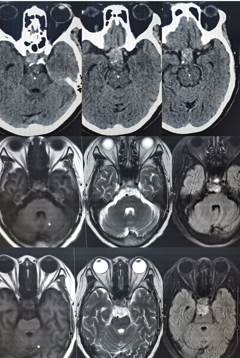 颈内动脉血栓和闭塞,颈内动脉漂浮血栓